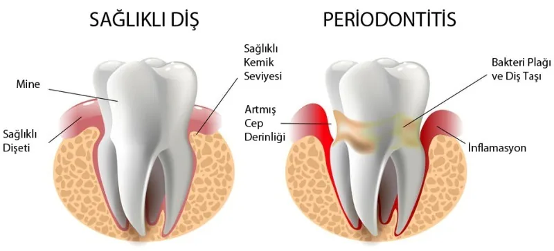 Diş Eti Hastalıkları (Periodontoloji) — 2