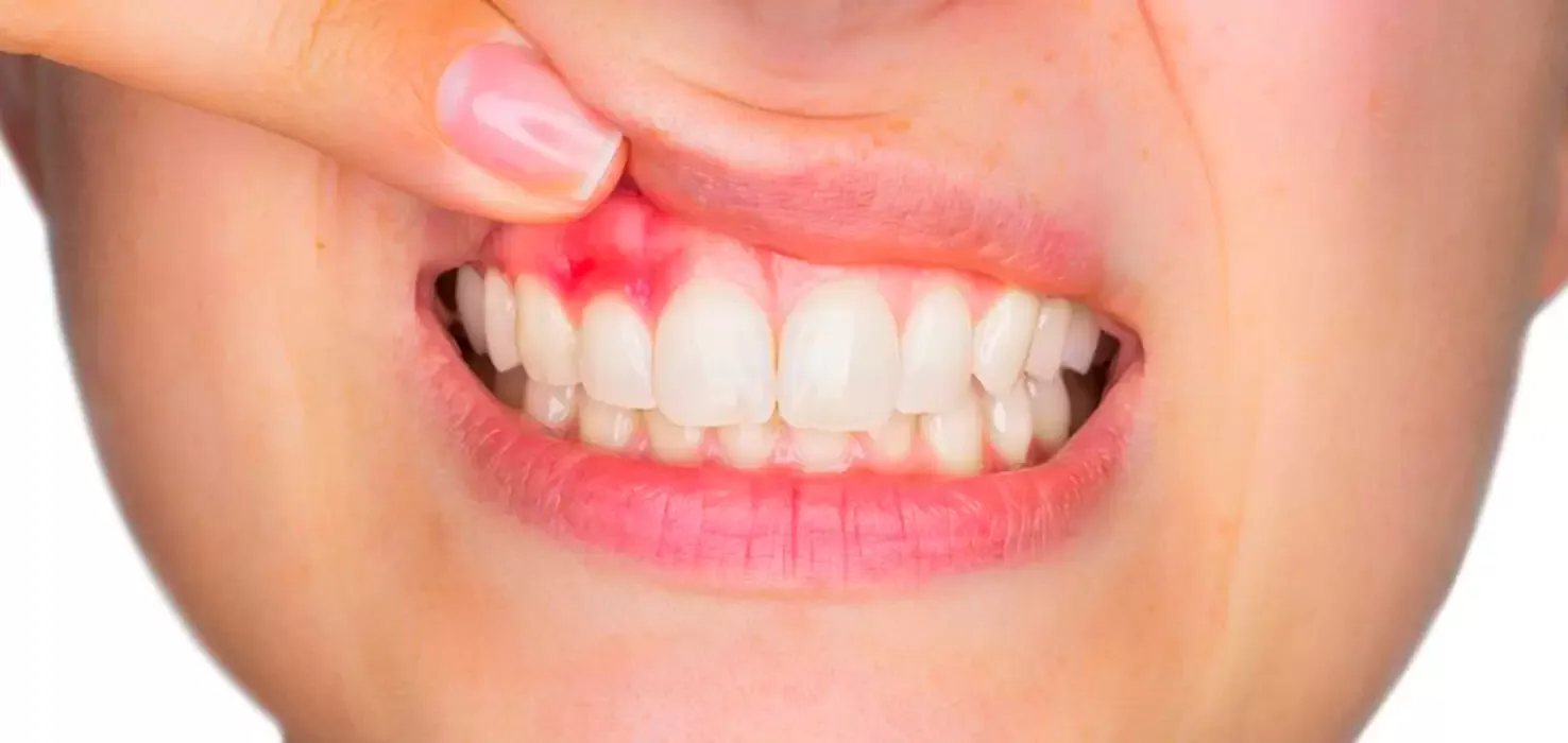Diş Eti Hastalıkları (Periodontoloji)