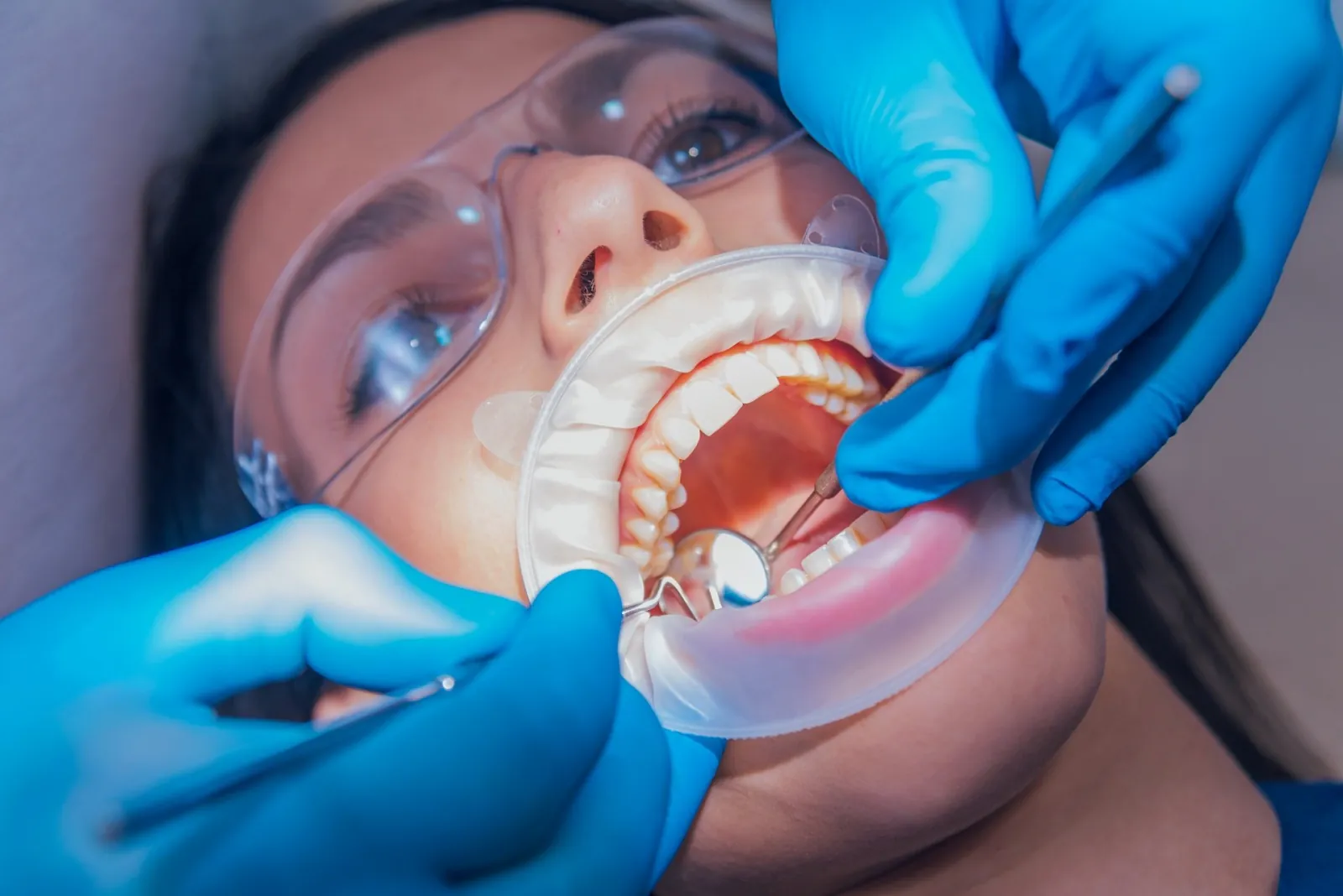 Kanal Tedavisi (Endodonti) — 1