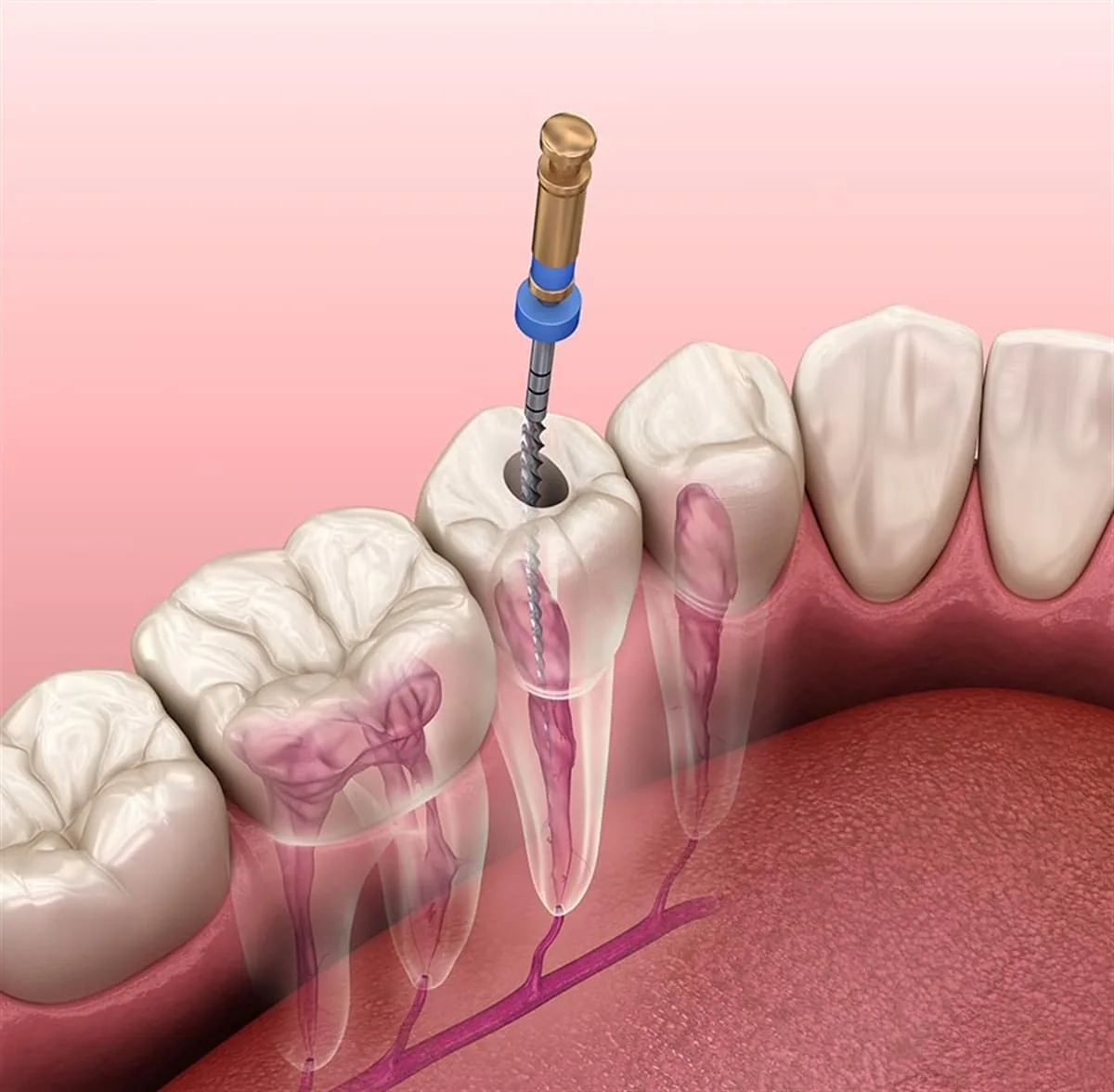 Kanal Tedavisi (Endodonti) — 2
