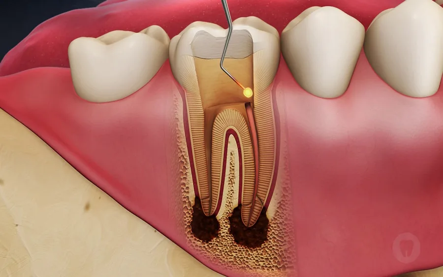 Kanal Tedavisi (Endodonti) — 3